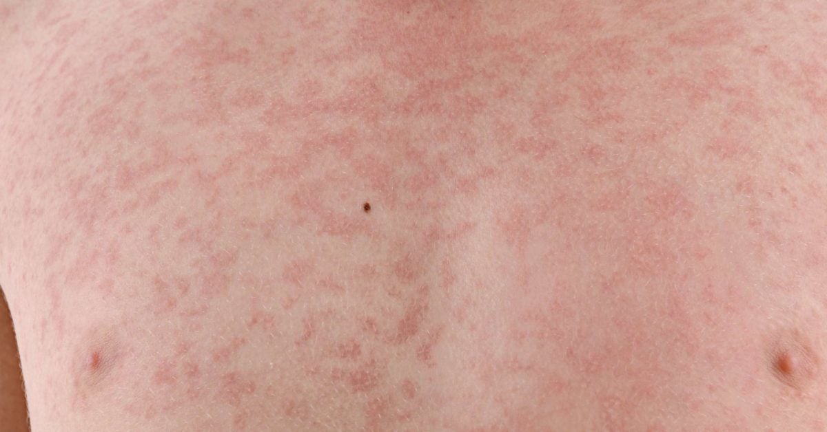 Rubella German Measles Symptoms Treatment During Pregnancy