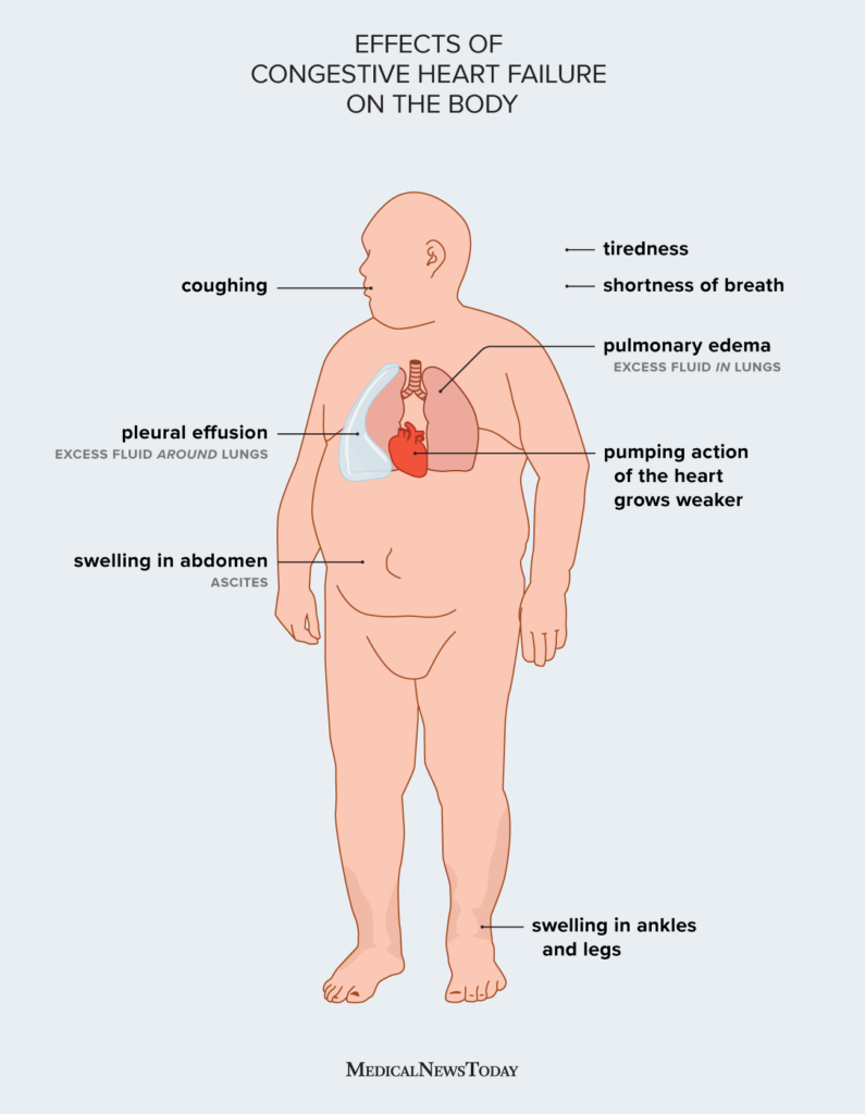 Congestive Heart Failure Symptoms Treatment And More