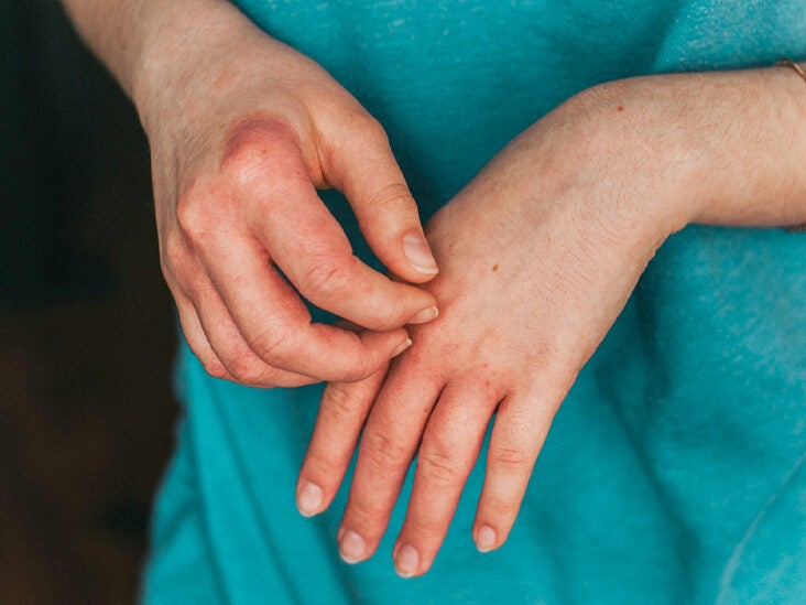 eczema e sol vörös foltok jelentek meg a fején viszket és pelyhezett