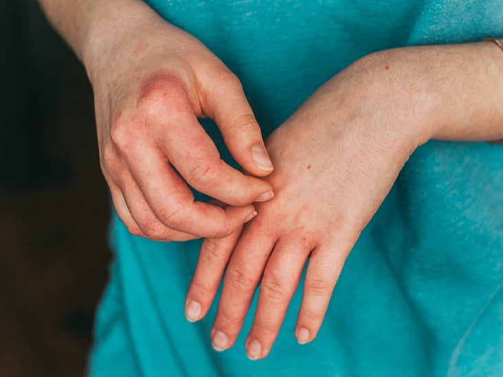 vörös foltok jelentek meg a kezeken és a testen gyógynövénykészítmények pikkelysömör kezelésére