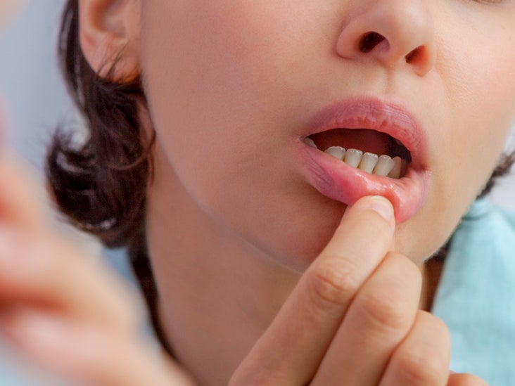 Blood Blister In Mouth Causes Treatment Symptoms And More