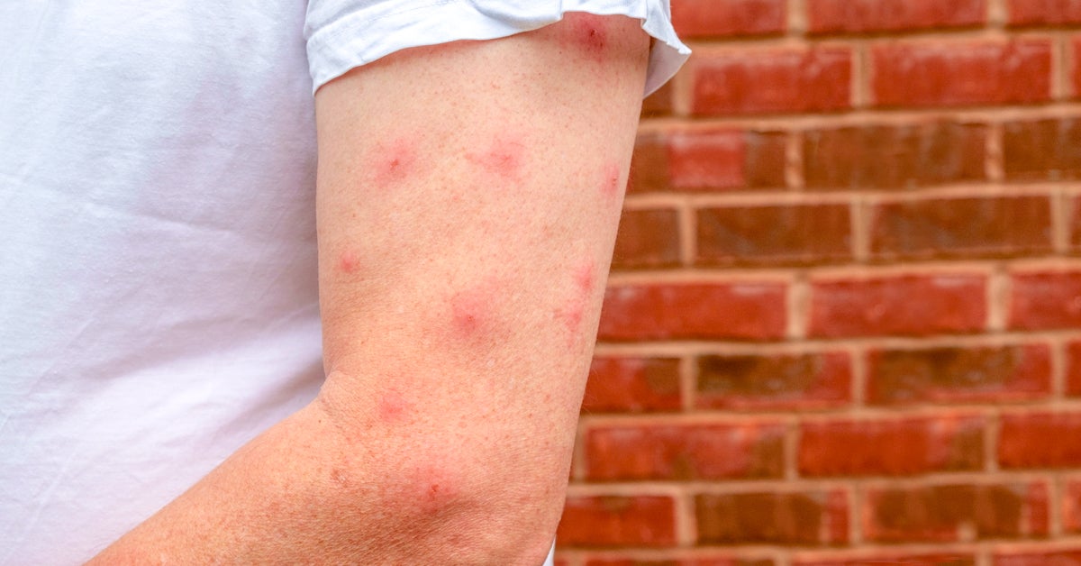 Can You Pop A Mosquito Bite With A Needle Mosquito Bite Blisters What Causes Them And How To Treat Them