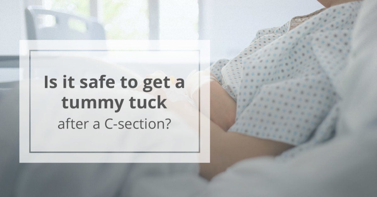 Tummy Tuck After CSection Is It Safe?