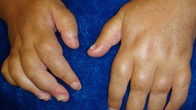 Tenyeres pustularis psoriasis arthritis
