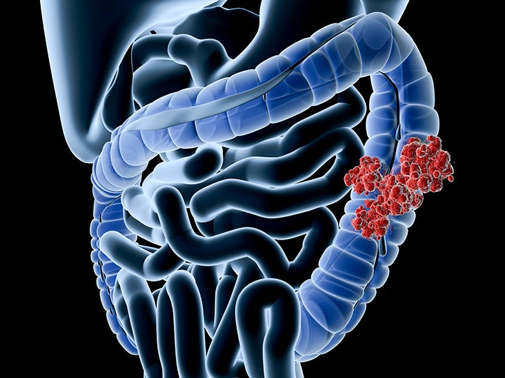 colorectal cancer is)
