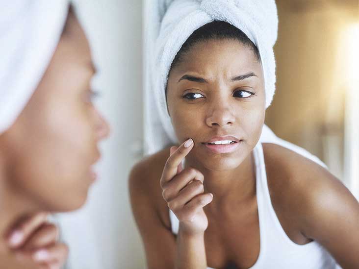 9 Fever Blister Remedies Causes And More