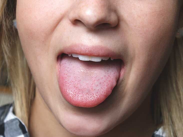 white papilloma on tongue