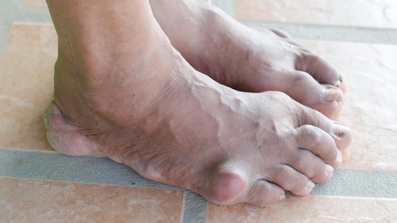 Gout Symptoms Causes And Treatment