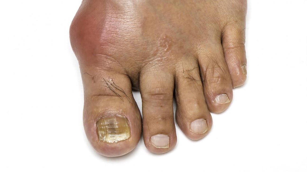 Gout Symptoms Causes And Treatment