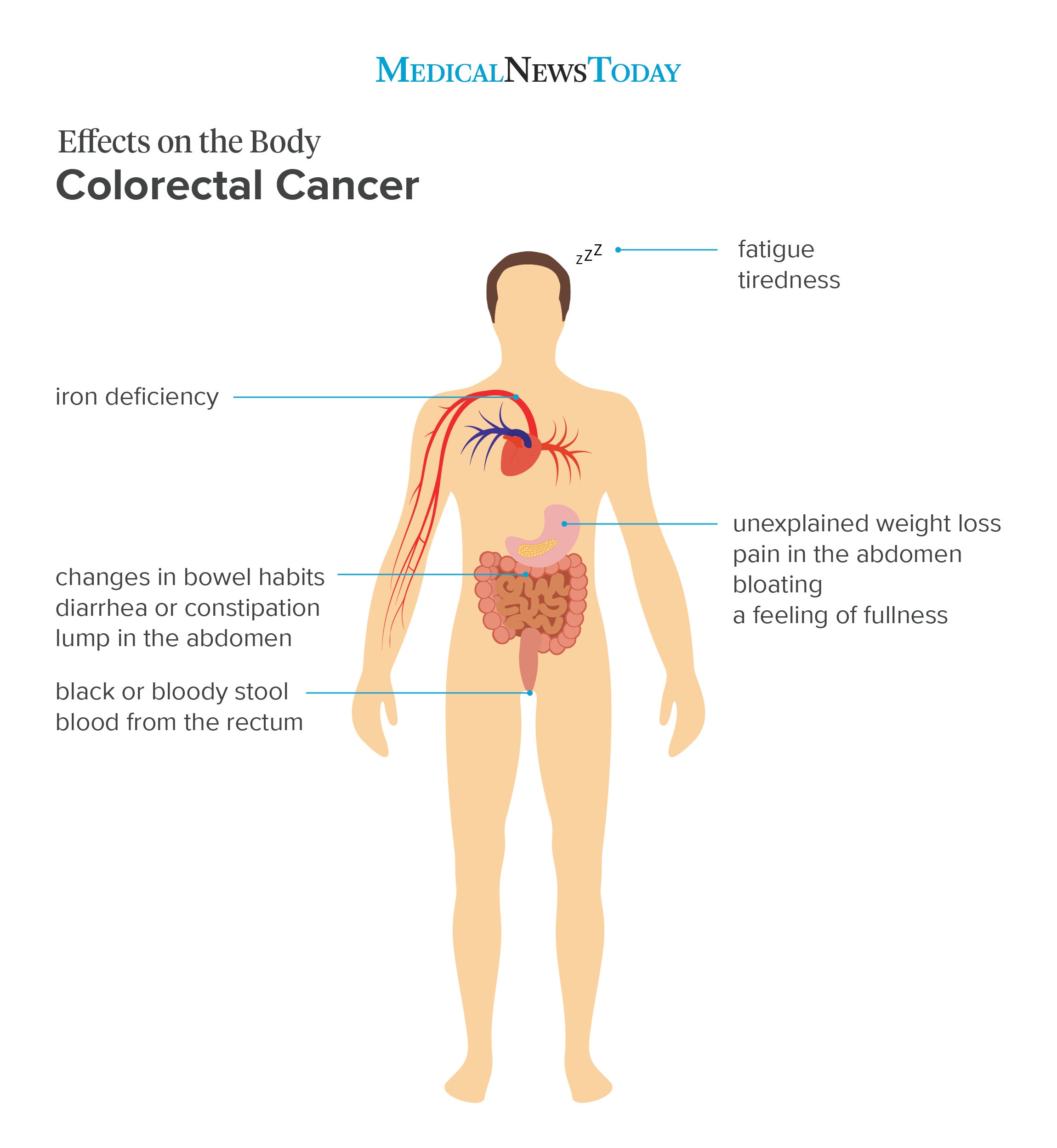 Colorectal Cancer Symptoms Treatment Risk Factors And Causes