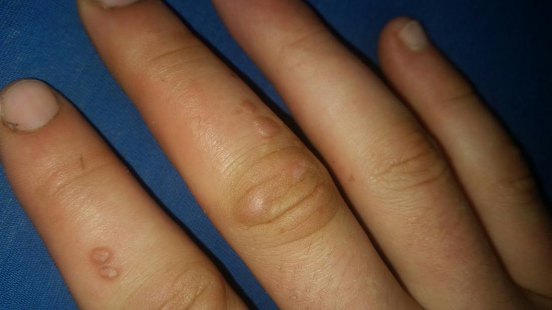 Wart on hand skin