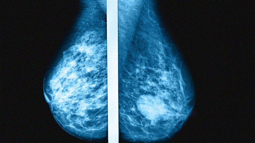 Cancer Changed My Breasts, Not My Sexuality