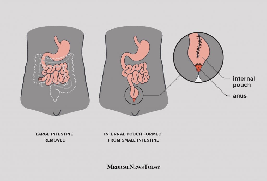 Ulcerative colitis surgery Procedure, recovery, what to expect