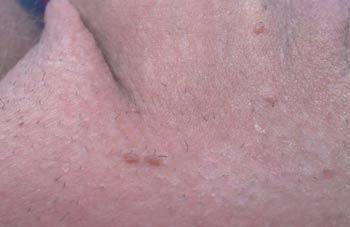 Genital Rash Causes Pictures Symptoms And Treatment
