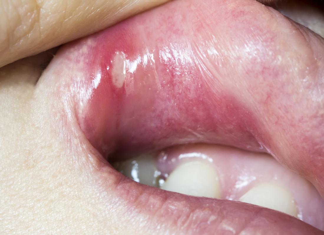 Mouth ulcers Types causes symptoms and treatment