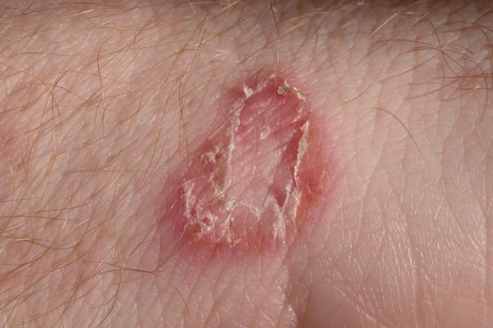 Blisters on groin area outlet female