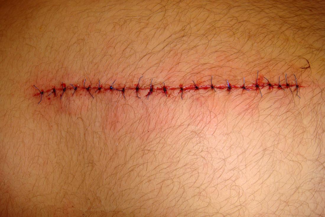How to remove stitches safely at home