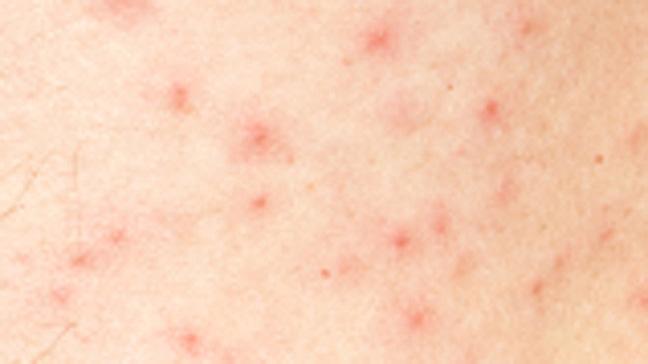 Rash the Causes and when to see a doctor