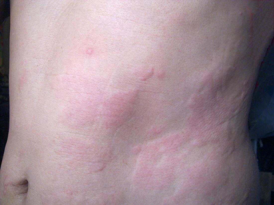 Red marks on breasts, non-itchy & non-painful. They hang around