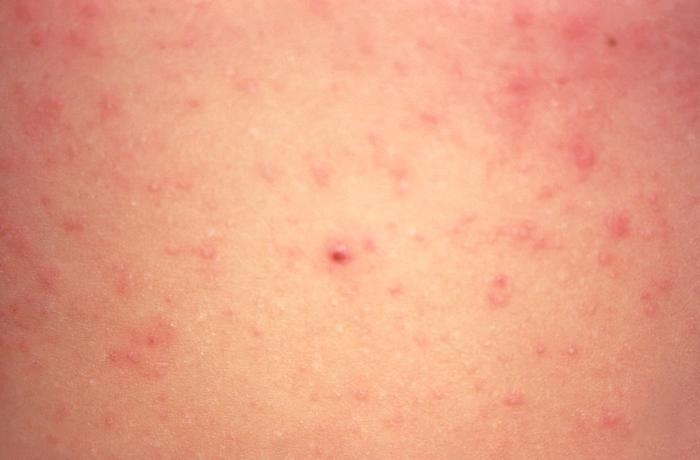 Rash under breast: Causes, treatments, and more