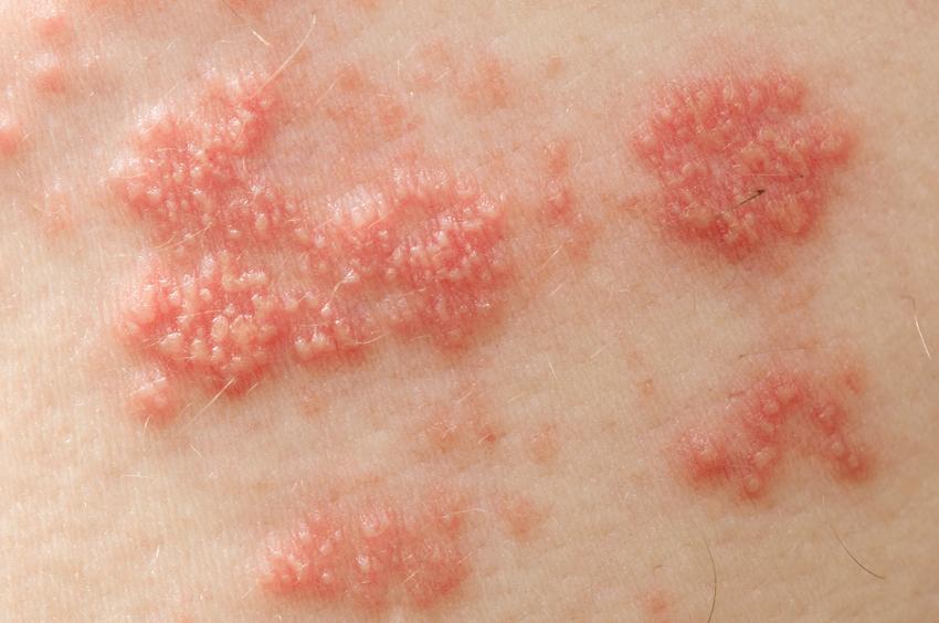 Rash the Causes and when to see a doctor