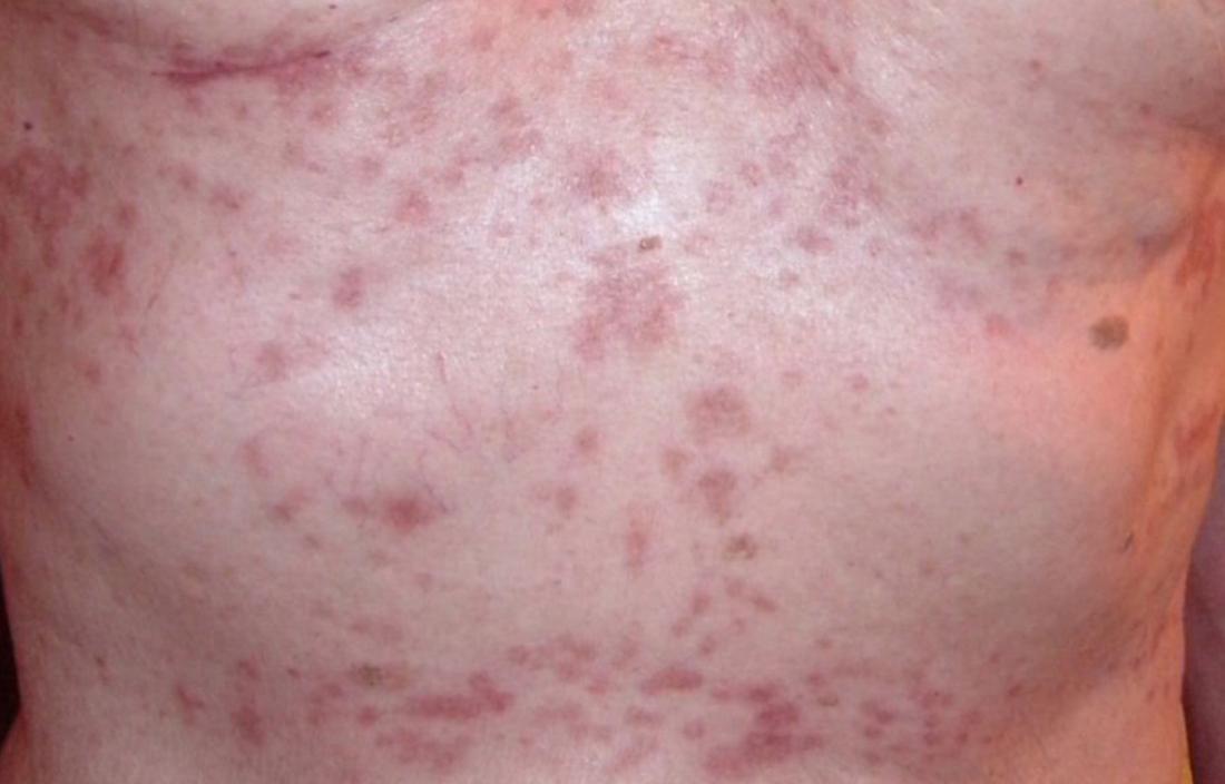 Rash Under Breast Causes Treatments And More