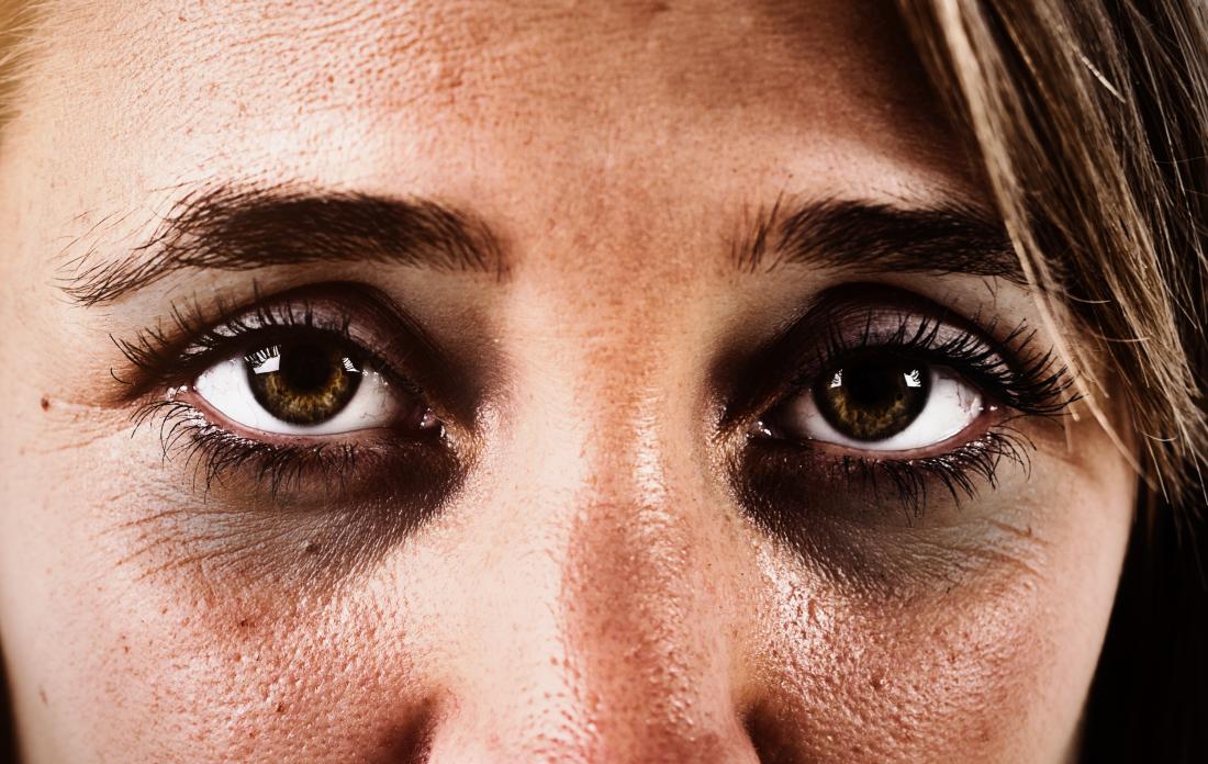 dark-circles-under-the-eyes-causes-and-treatments