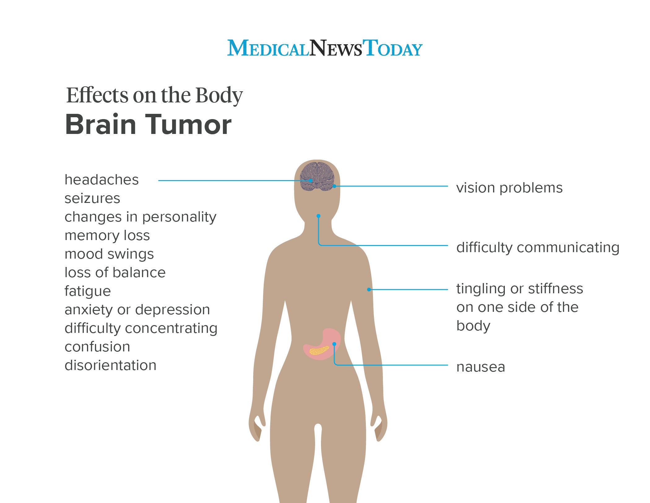 Early signs and symptoms of a brain tumor