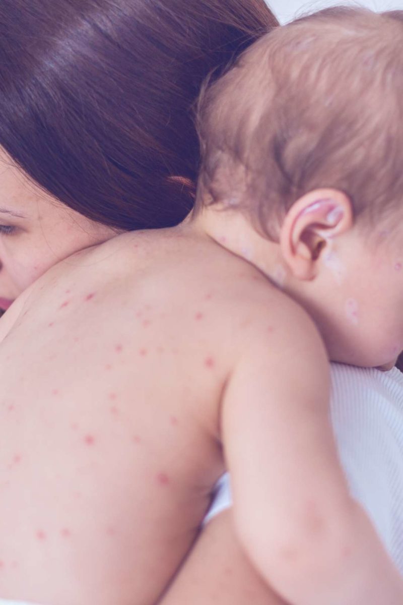 chicken pox on babies