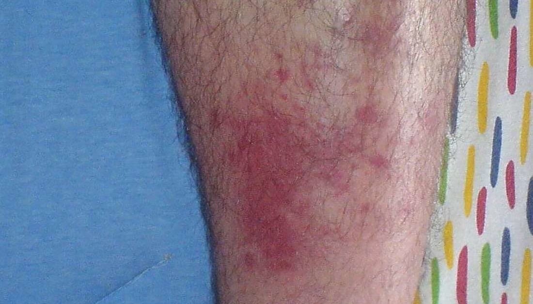 Cellulitis from bug bites: Signs, symptoms, and treatment