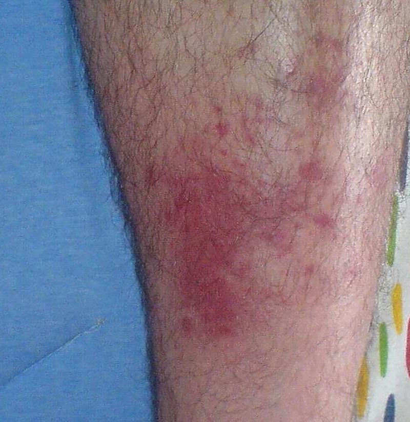 Bug Bite Vs Staph Infection