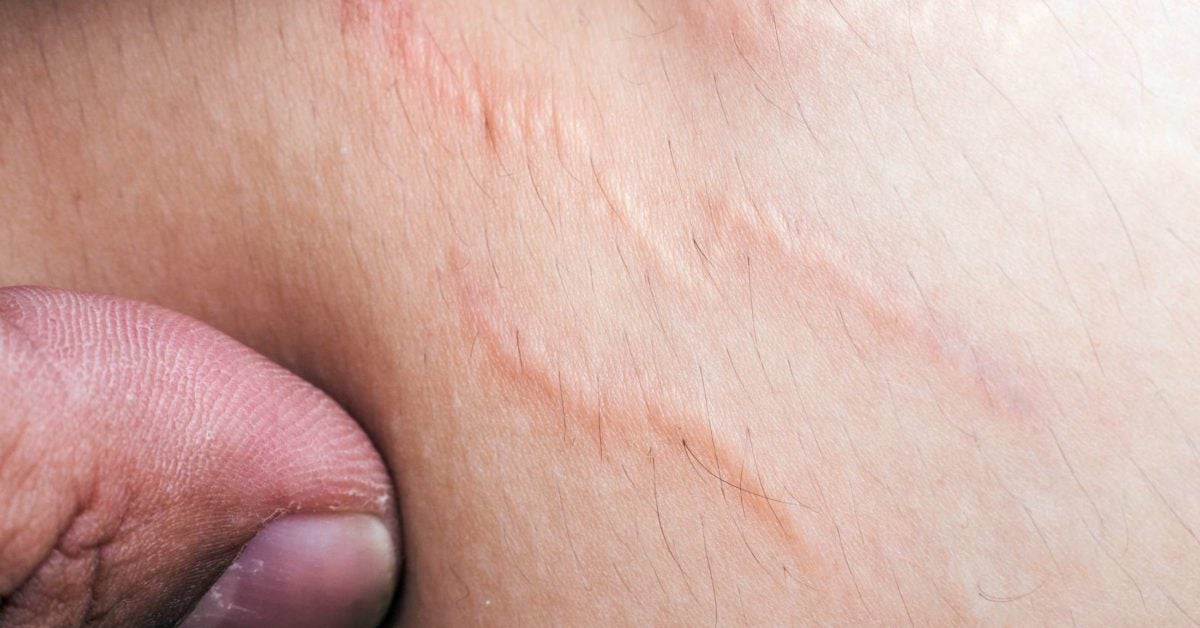 Stretch marks on thighs: Appearance, causes, and treatments
