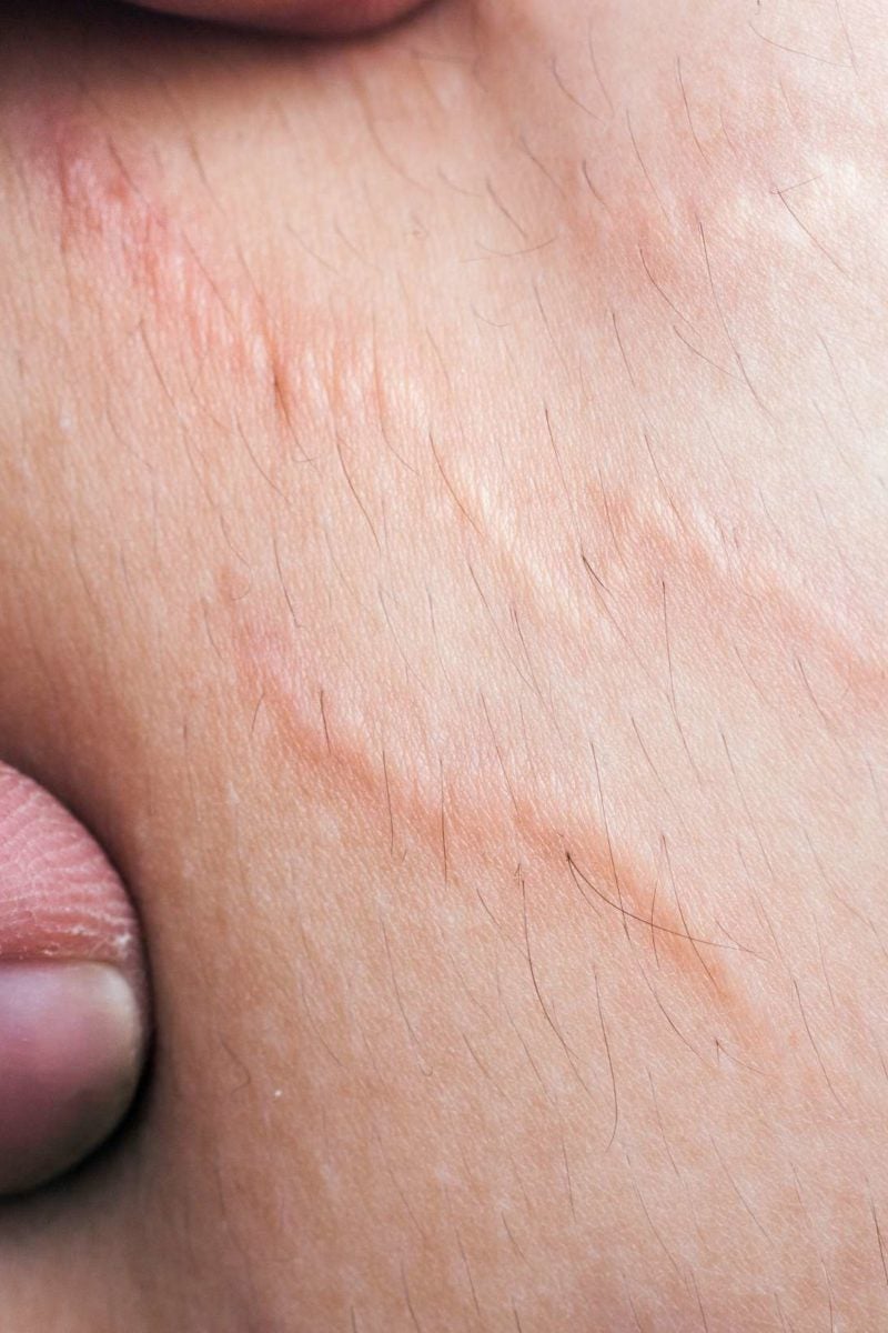 Does Scratching Cause Stretch Marks? – TriLASTIN