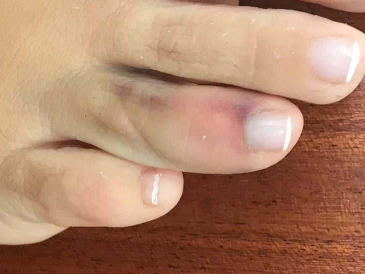 Stubbed toe: When is it serious, and what are the treatments?