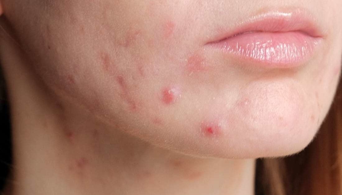 Pregnancy acne: Treatments and home remedies
