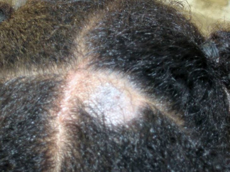 Hair loss in children: Causes, other symptoms, and treatments