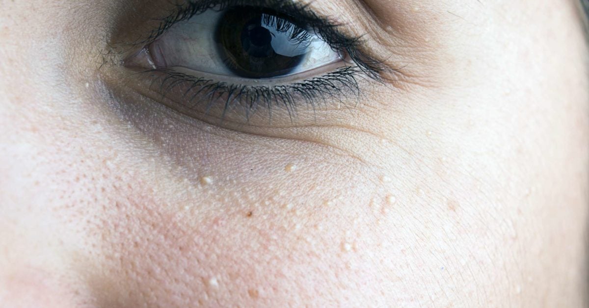 Milia under eyes: Causes, diagnosis, and treatment