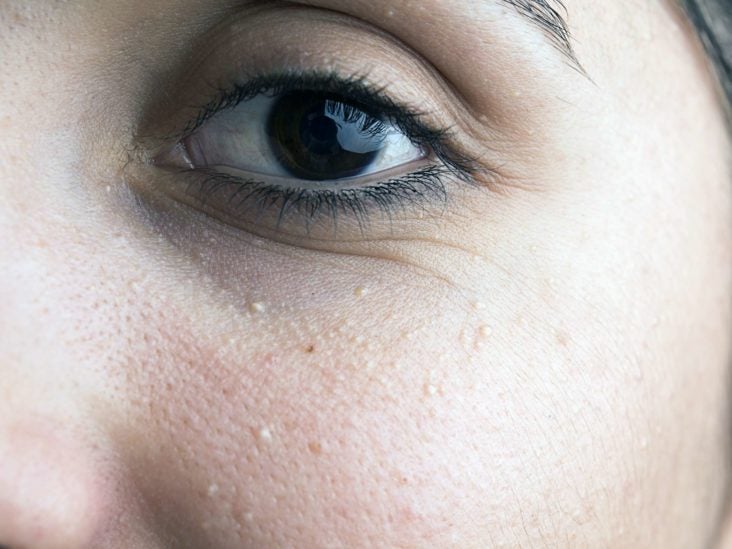 Milia under eyes: Causes, diagnosis, and treatment