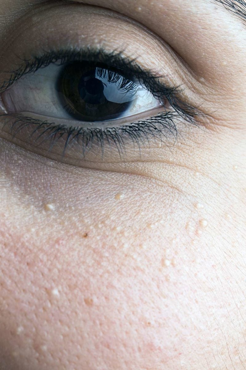 Milia under eyes: Causes, diagnosis, and treatment