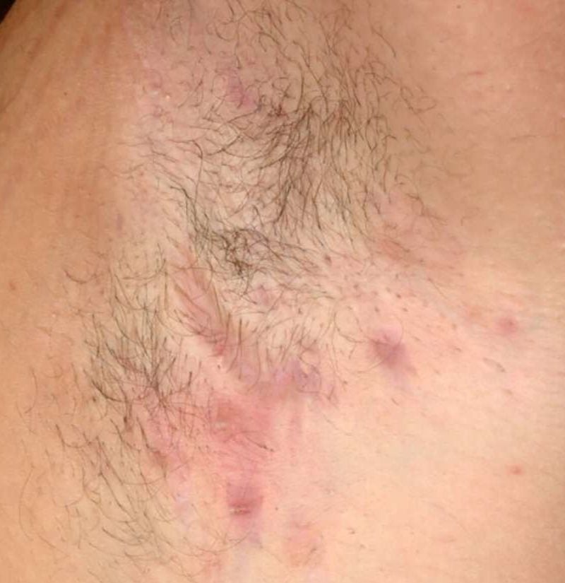 How do i get rid of these HS scars on inner thighs , : r/Hidradenitis
