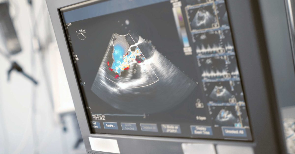 2d-echo-test-cost-2-d-echocardiography-tests-in-india