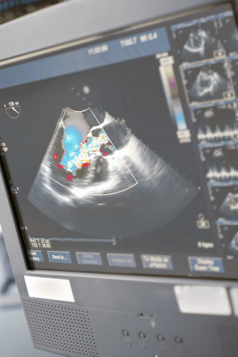 what-is-an-echocardiogram-uses-procedure-and-results