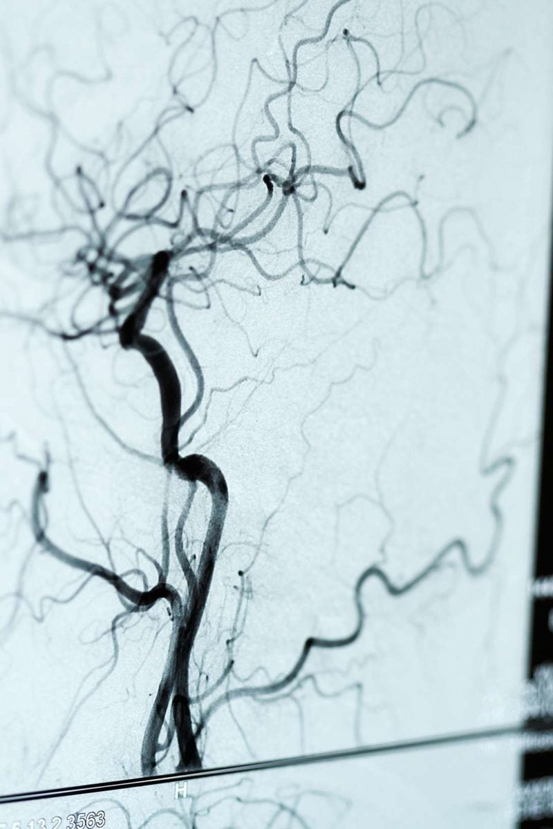 What is an angiogram? Uses, procedure, and results