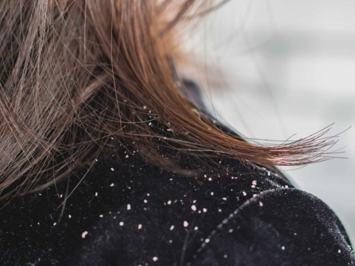 Seborrheic dermatitis hair loss: Causes and treatment