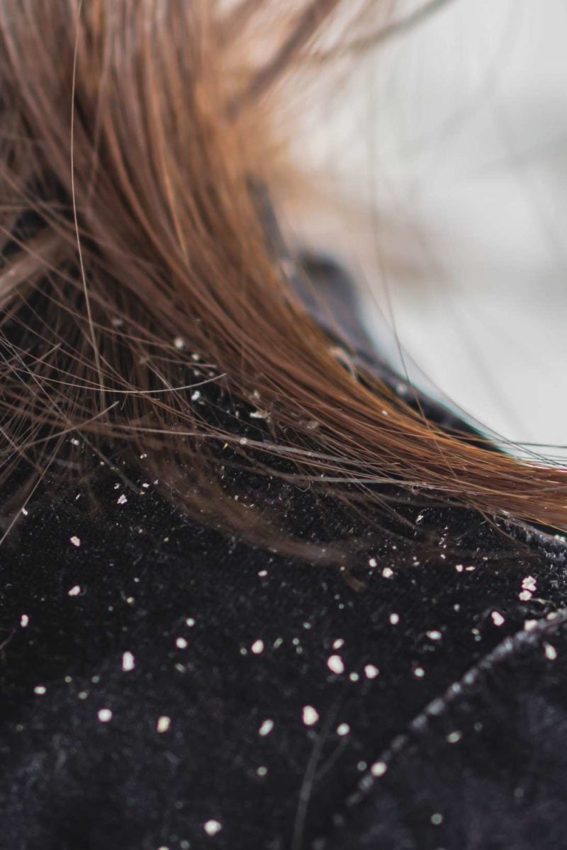 hair with dandruff