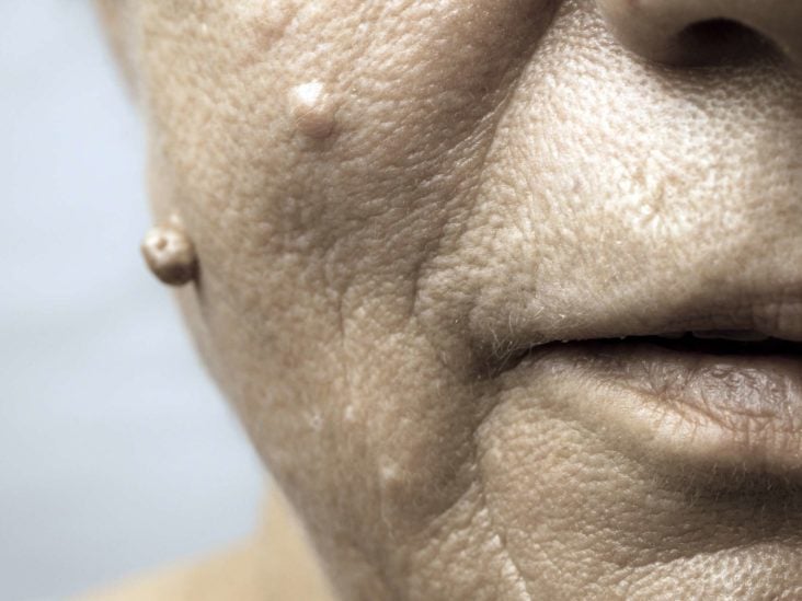 papilloma on the face cura detoxifiere ficat si fiere