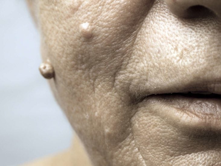 hpv skin warts on face)