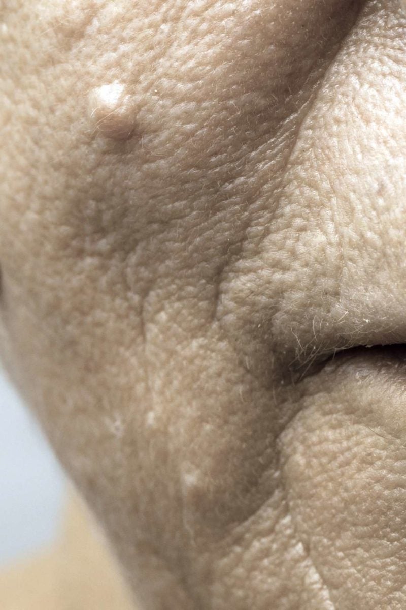 How to get rid of warts on the face