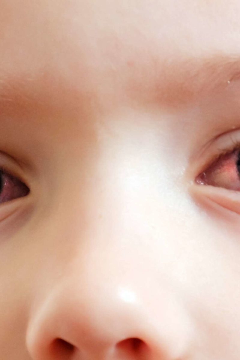 Pink eye in toddlers Symptoms, diagnosis, and treatment