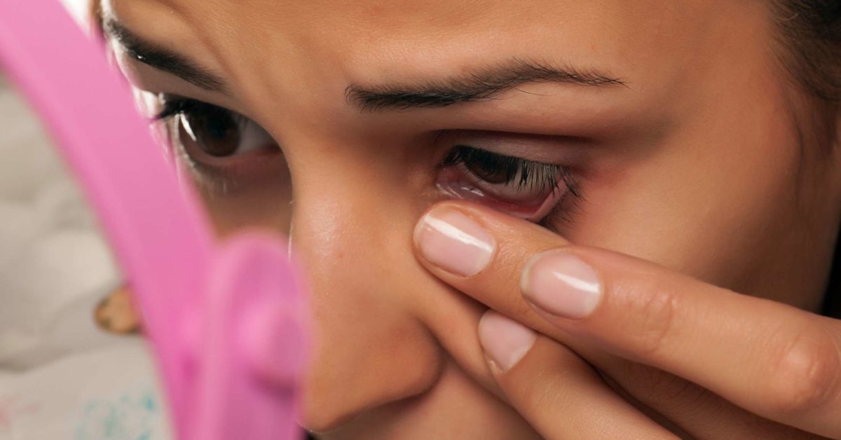 skin tags on eyelids bentadine